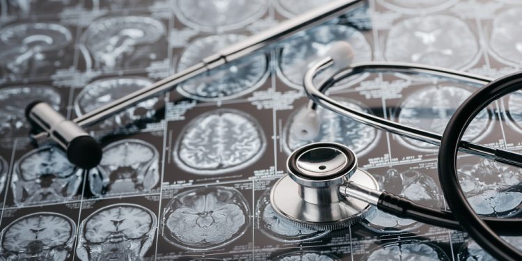 Причины отрыва вен мозга – сложное заболевание – Орен Зариф